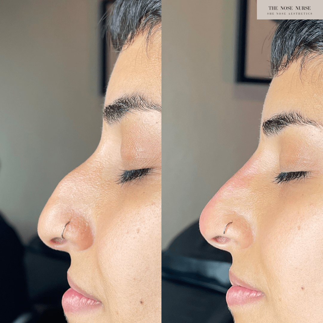plastic surgery on the nose